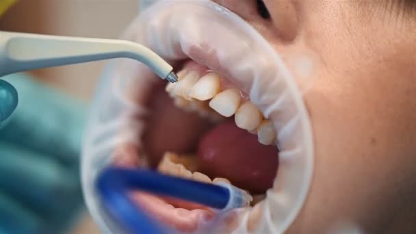 Příprava Instalaci Složených Závorek Tzubů Zubní Péče Zavřít — Stock video