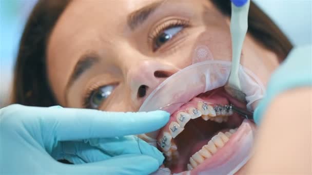 歯科医は忍耐強い支柱にアークを取付す 極端なクローズアップ — ストック動画