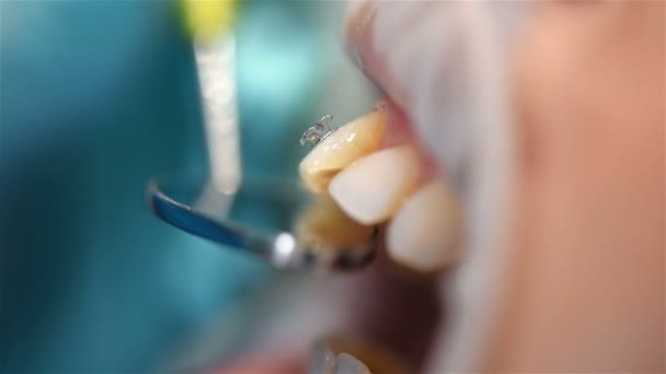 Dentysta Bada Zęby Zainstalowaniu Szelki Opieka Zdrowotna Gabinecie Stomatologicznym — Wideo stockowe