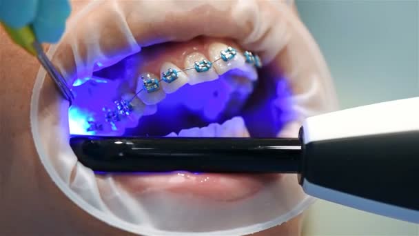 Zahnarzt Fixiert Zahnspangen Mit Einer Infrarotlampe Nahaufnahme Zeitlupeneffekt — Stockvideo
