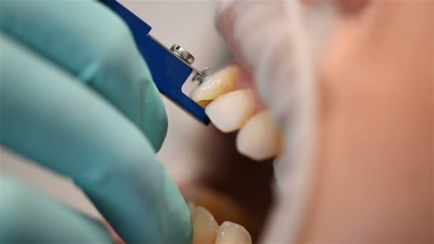 Inspección Instalación Aparatos Ortopédicos Por Dentista Denal Clinic Extremo Primer — Vídeo de stock