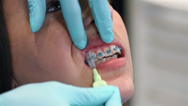 Dentista Limpia Los Dientes Después Instalar Aparatos Ortopédicos Primer Plano — Vídeos de Stock