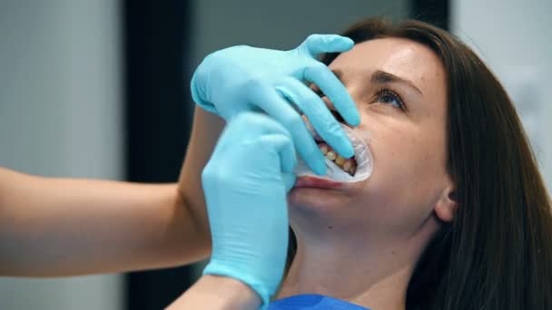 Mujer Dentista Pone Anillo Oral Boca Del Paciente Efecto Cámara — Vídeos de Stock