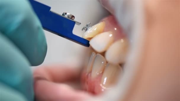 检查牙科医生在德纳尔诊所的支架安装 极端特写 — 图库视频影像