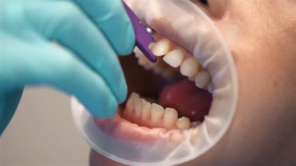 Dentista Femenina Instalando Aparatos Ortopédicos Paciente Cerca Efecto Cámara Lenta — Vídeo de stock