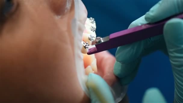 치아에 중괄호를 고정하기위한 익스트림 클로즈업 — 비디오