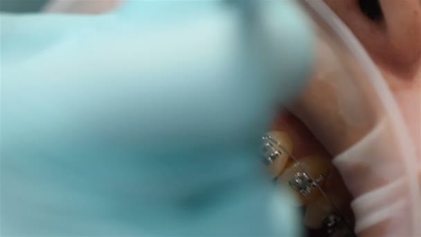 Стоматолог Робить Кріплення Гумки Брекет Системі Пацієнта Клініці Денілу Екстремальна — стокове відео