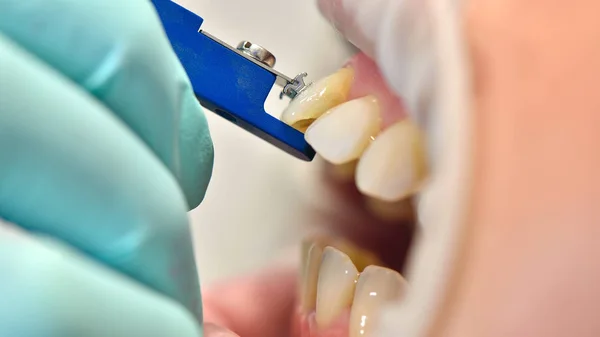 Fijación de frenillos en los dientes — Foto de Stock
