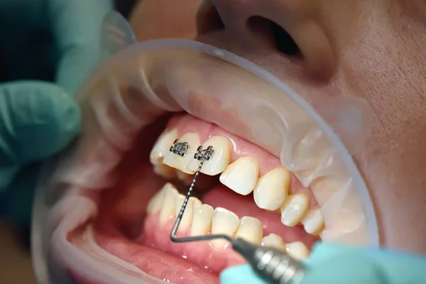 Inspection Of Braces — Stock Photo, Image