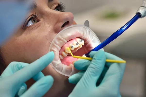 Diş hekimi hastanın dişlerini hazırlar — Stok fotoğraf
