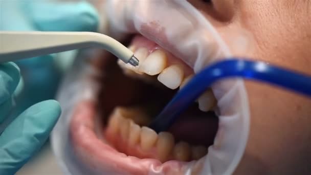 Preparando Para Instalar Aparelhos Nos Dentes Tratamento Dentário Close — Vídeo de Stock