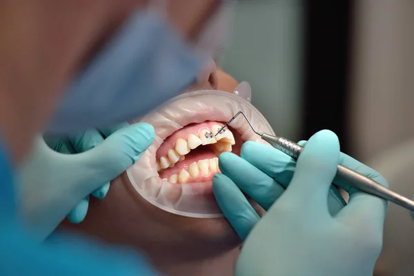 Встановлення дужок стоматологом . — стокове фото