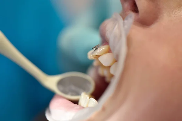 Dentista Examina Los Dientes Después Instalar Aparatos Ortopédicos Concepto Atención —  Fotos de Stock