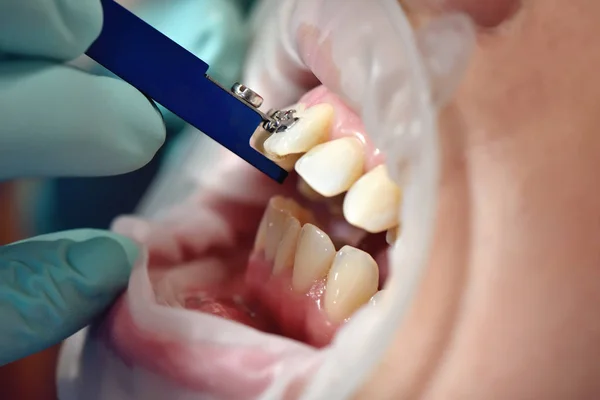 Inspectie van de montage van beugels door de tandarts — Stockfoto