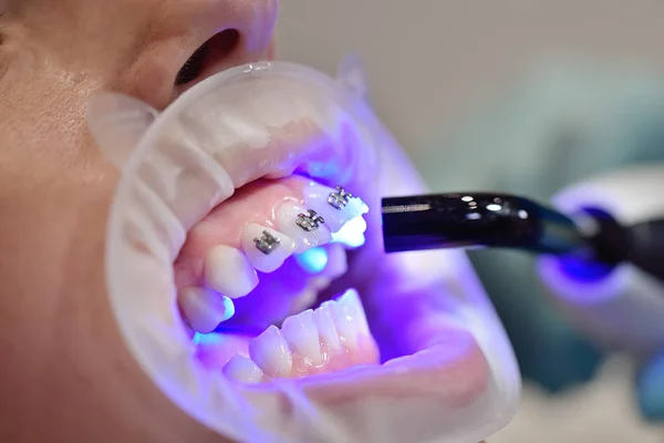 Dentista fija aparatos ortopédicos — Foto de Stock