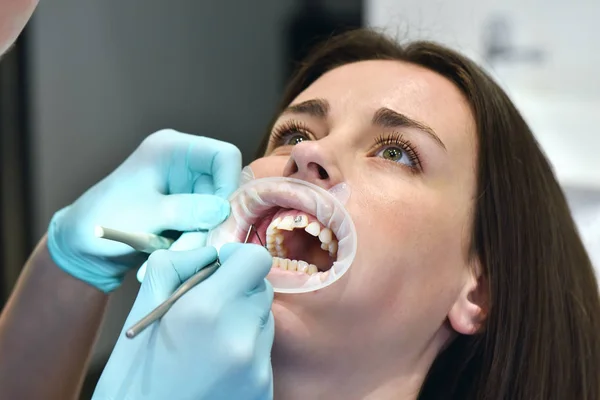 Förbereda sig för att installera tandställning på tänder — Stockfoto