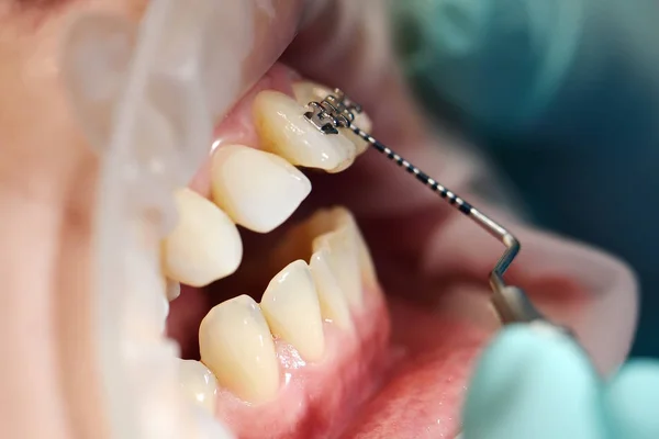 Inspección de la instalación de aparatos ortopédicos por dentista —  Fotos de Stock