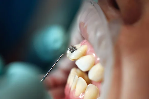 Preparación para instalar aparatos ortopédicos en los dientes —  Fotos de Stock