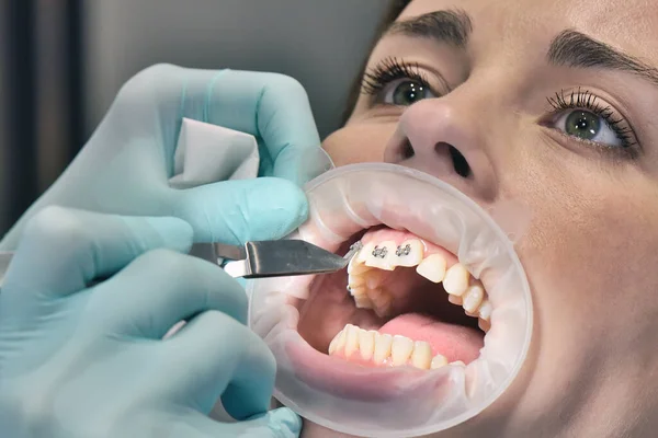 Процедура Закріплення Брекетів Зубах Стоматологічна Охорона Здоров Медична Концепція Крупним — стокове фото