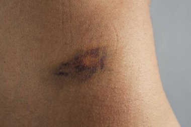 closeup of the flank of a caucasian man with a hematoma clipart