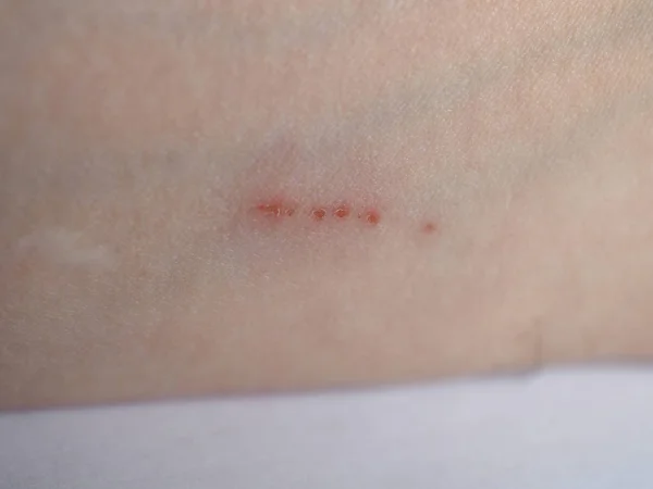 Graffio cicatrice sul braccio — Foto Stock