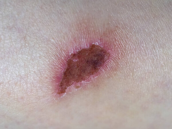 scar tissue following abrasion graze on human limb skin