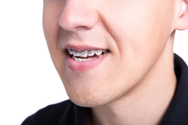 Close Young Man Braces Teeth — Stock Photo, Image