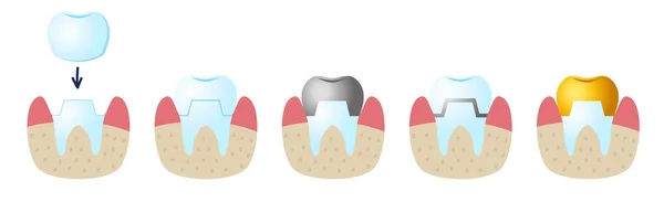 Иконы на зубной щетке. Сервисная установка керамической короны. — стоковый вектор