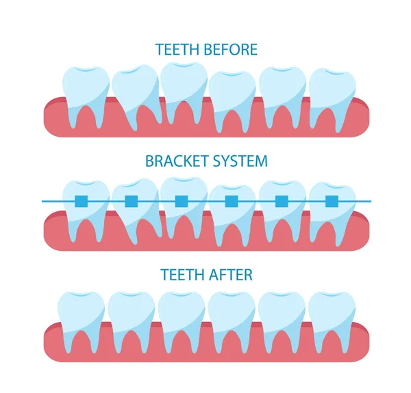 El proceso de corrección de dientes con aparatos ortopédicos. — Archivo Imágenes Vectoriales