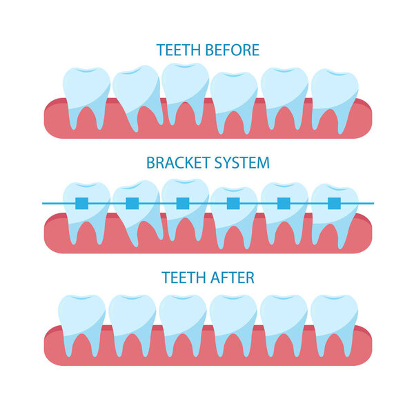 The process of correction of teeth with orthopedic braces.