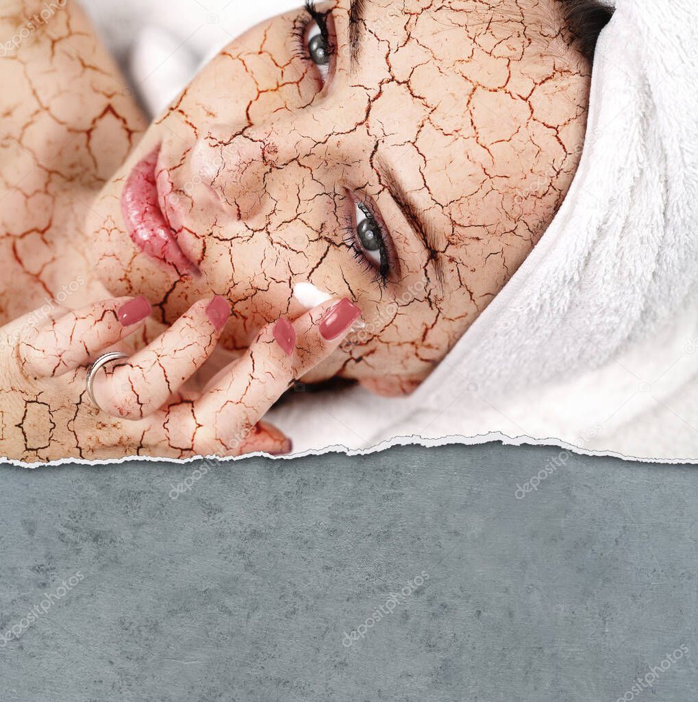 Woman applying moisturizing cream on her cracked skin
