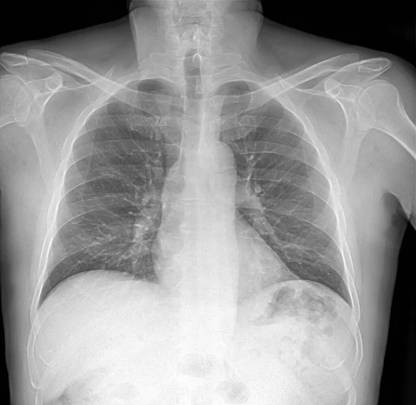 Рентгеновское Изображение Легких Пневмонией — стоковое фото
