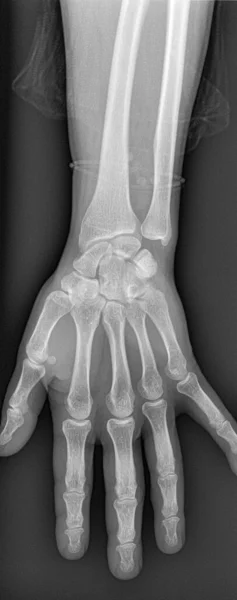 Raio Mão Artrite Reumatoide Artrite Reumatoide Uma Doença Autoimune Longo Imagens Royalty-Free