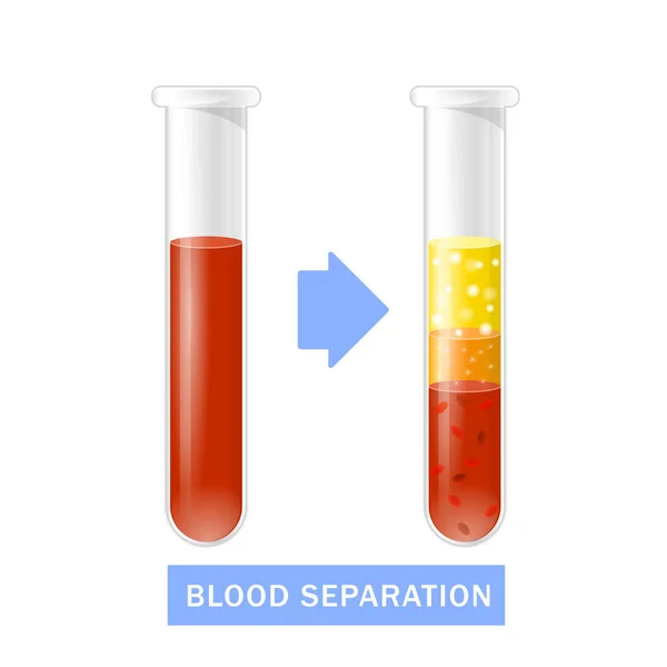 Tubo de ensayo con sangre después de la separación de plaquetas, PRP — Archivo Imágenes Vectoriales