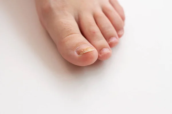 foot with nail fungus