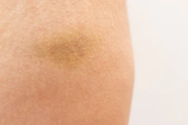 Žlutá Modřina Kůži Stehně Zranění Ženské Nohy — Stock fotografie