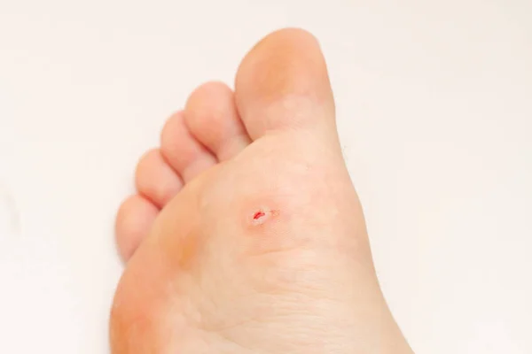 Plantarwarze Fuß Offene Wunde Nach Der Warzenentfernung Der Fußsohle Papillomavirus — Stockfoto