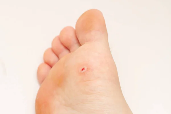 Ayakta siğil var. Ayak tabanında siğil alındıktan sonra açık yara. Papillomavirus.