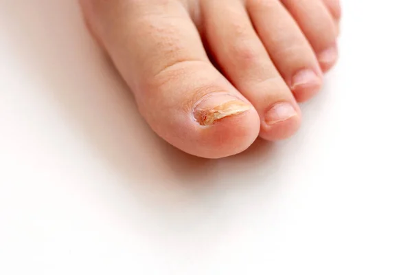 Primo piano dell'unghia del piede con infezione da funghi — Foto Stock