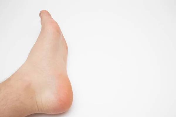 Le concept de pieds plats sur fond blanc. Homme pieds — Photo