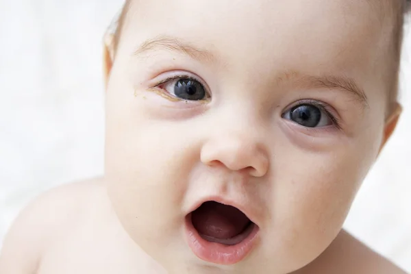 An infant with soured eyes suffers from conjunctivitis — Stock Photo, Image