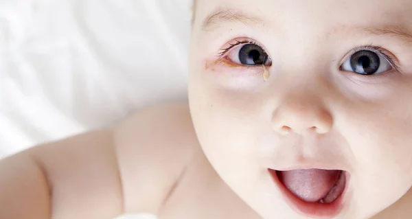 Seorang bayi dengan mata yang memburuk menderita konjungtivitis — Stok Foto