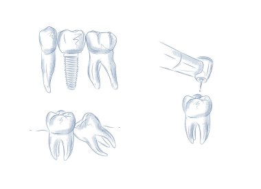 Dişi diş makinesiyle delin, implant yapın, hasta diş örneklerini çıkarın, beyaz arka planda maviyle çizim yapın..