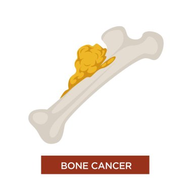 Marrow disease bone cancer, malignant tumor and oncology vector icon clipart