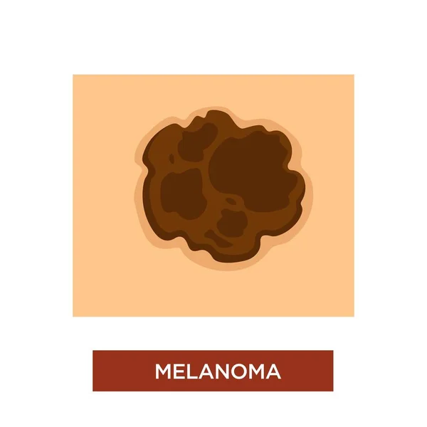 Skin Cancer Melanoma Vector Birthmark Dark Spot Human Body — Stock Vector