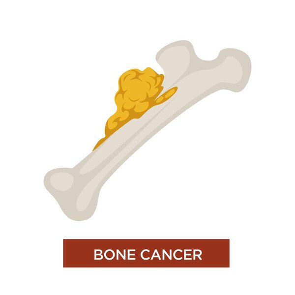 Marrow disease bone cancer, malignant tumor and oncology vector icon