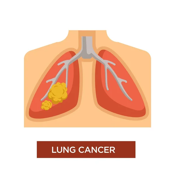 Onkologie Oder Lungenkrebs Und Tumorerkrankungen Vektor — Stockvektor