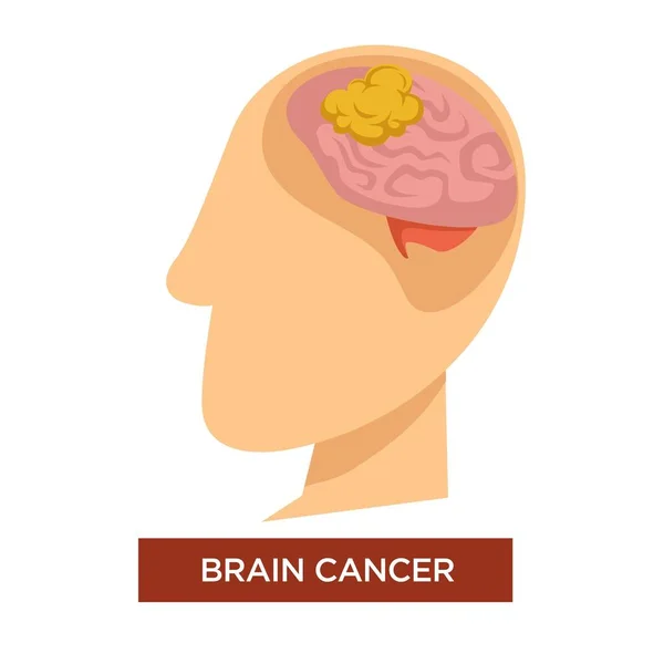 Rakoviny Mozku Onkologických Onemocnění Chemoterapie Samostatný Vektor — Stockový vektor