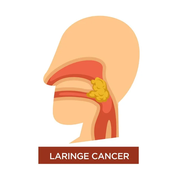 Hastalık Laringe Kanser Hastalığı Malign Veya Benign Tümör Boğazında Vektör — Stok Vektör