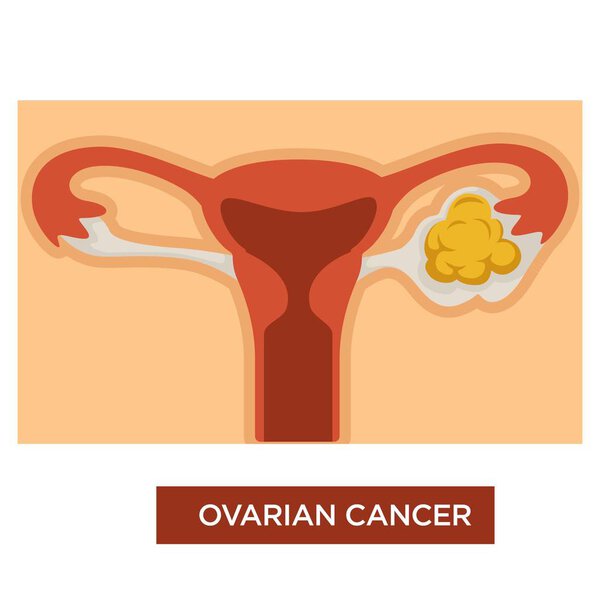 Female reproductive system, disease ovarian cancer, vector 
